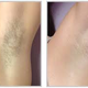Illustration for article titled LASER HAIR REMOVAL CHICAGO- EFFECTIVE HAIR REMOVALem/em
